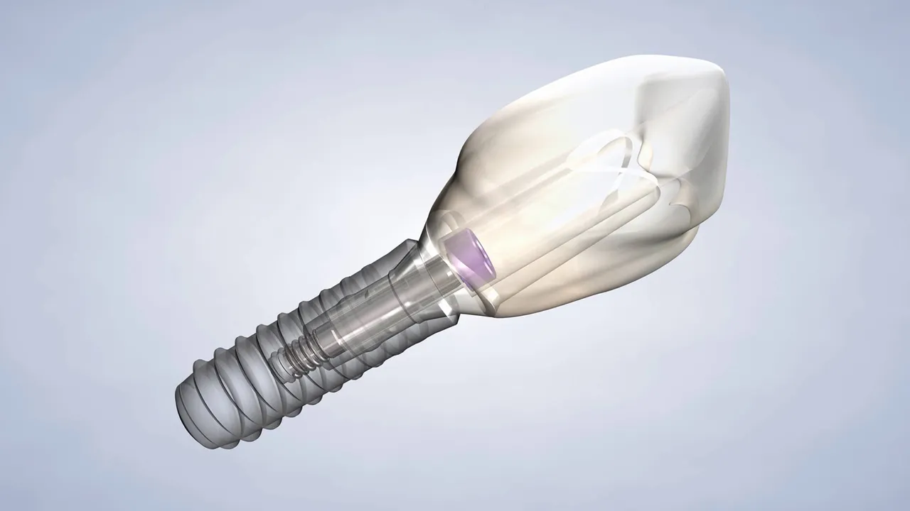 A dental implant