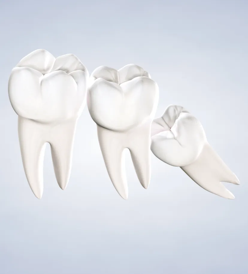 Procedure query page wisdom teeth removal